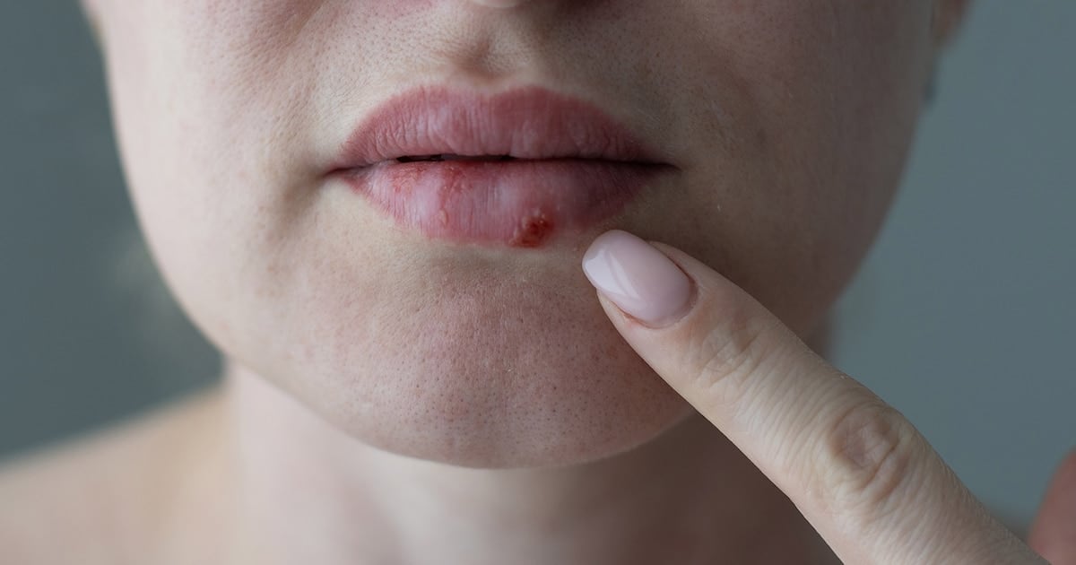 Un nuevo antiviral oral para el herpes resistente: la FDA le dio luz verde y hay expectativas en pacientes inmunocomprometidos