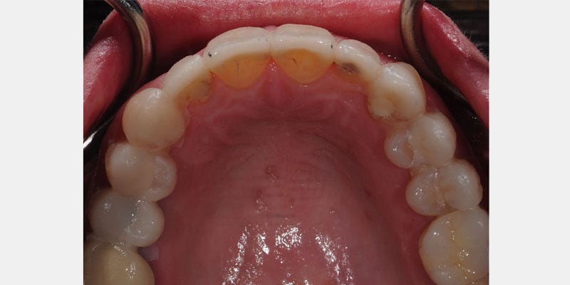Carillas dentales: la filtración puede empezar en un borde casi invisible